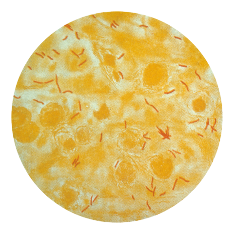 File:TB in sputum.png