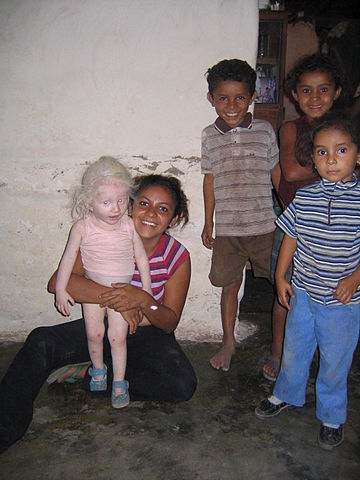 File:Albino girl honduras.jpg